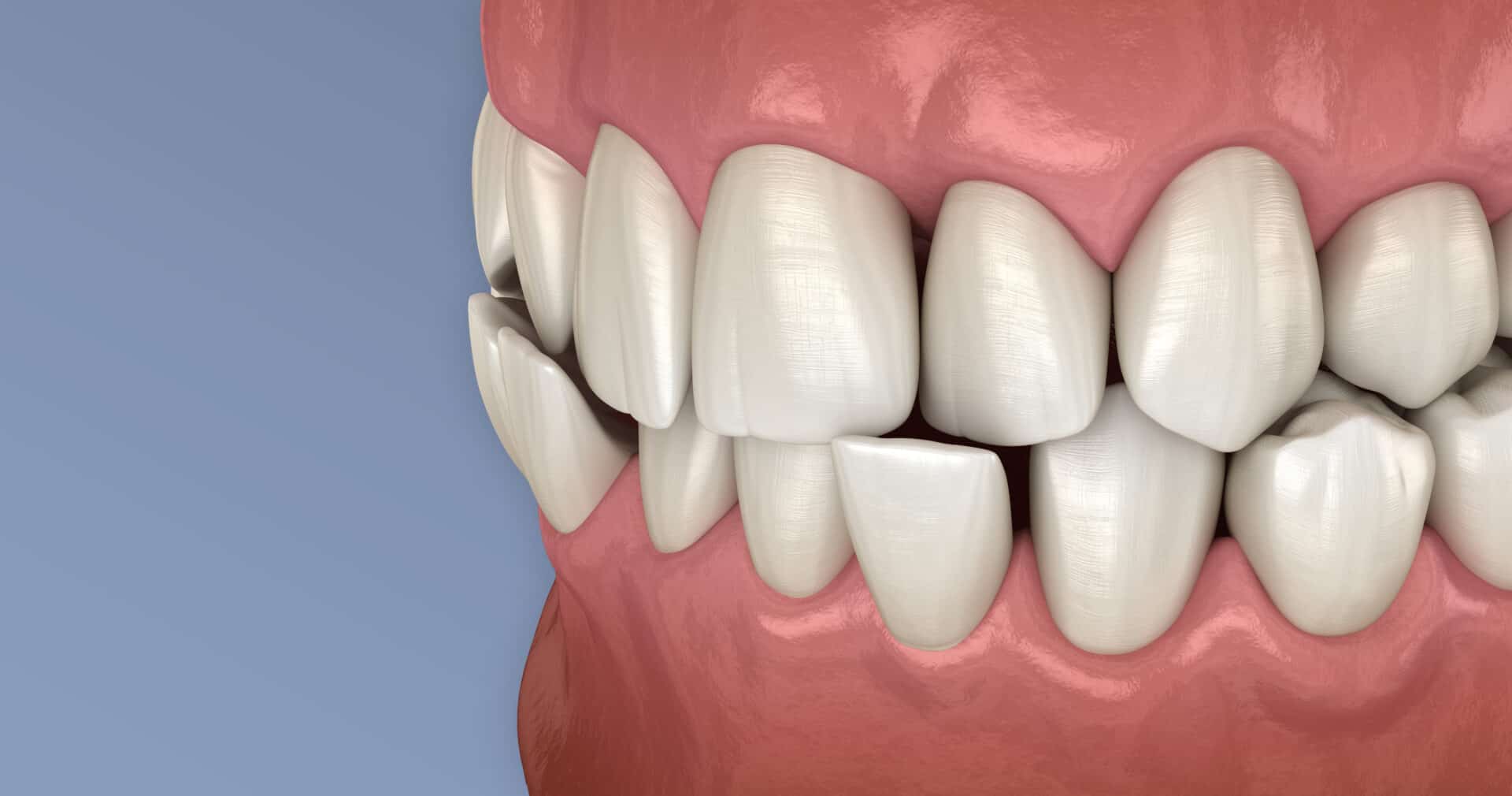 crossbite